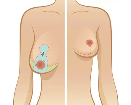 Fibroadenoma Diagram